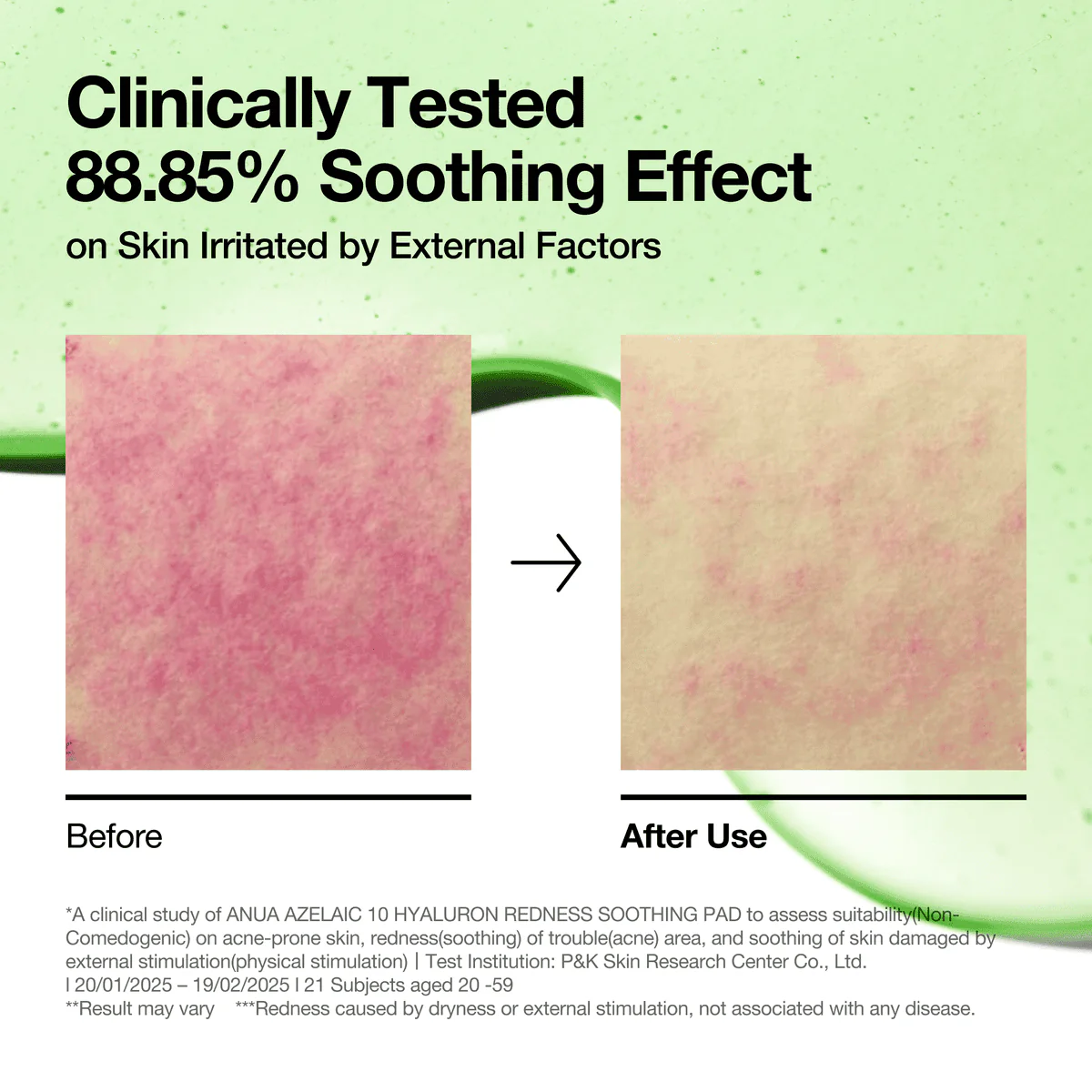 Anua Azelaic Acid 10+ Hyaluron Redness Soothing 90 Pieces - Image 4