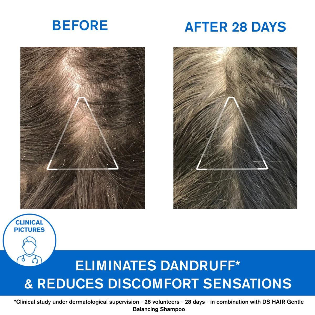 Uriage DS Hair Shampoo Anti Dandruff 200ml - Image 3
